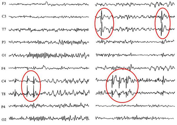Пример данных ЭЭГ: участки патологической эпилептиформной активности выделены красными кружками